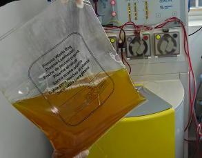 血液内科团队再攀新峰 首例血浆置换治疗高球蛋白血症圆满成功