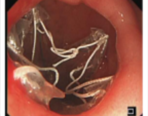 我院消化内科成功完成区内首例胃转流支架置入术